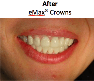 After: A More Natural Look